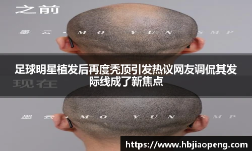 足球明星植发后再度秃顶引发热议网友调侃其发际线成了新焦点